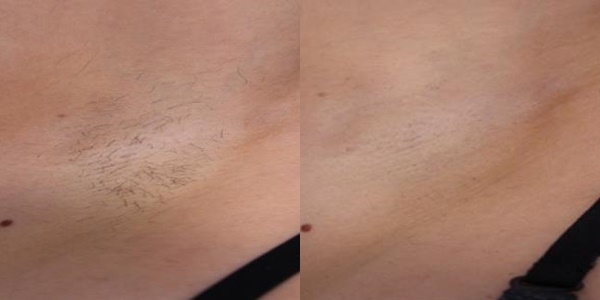 Primjer rezultata nakon ciklusa laserske epilacije Elysion Pro