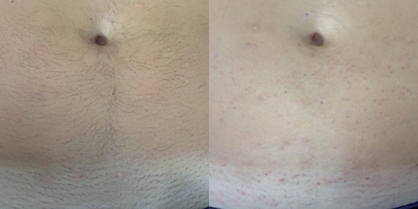 Primjer smanjenja vidljivosti dlačica nakon laserske epilacije