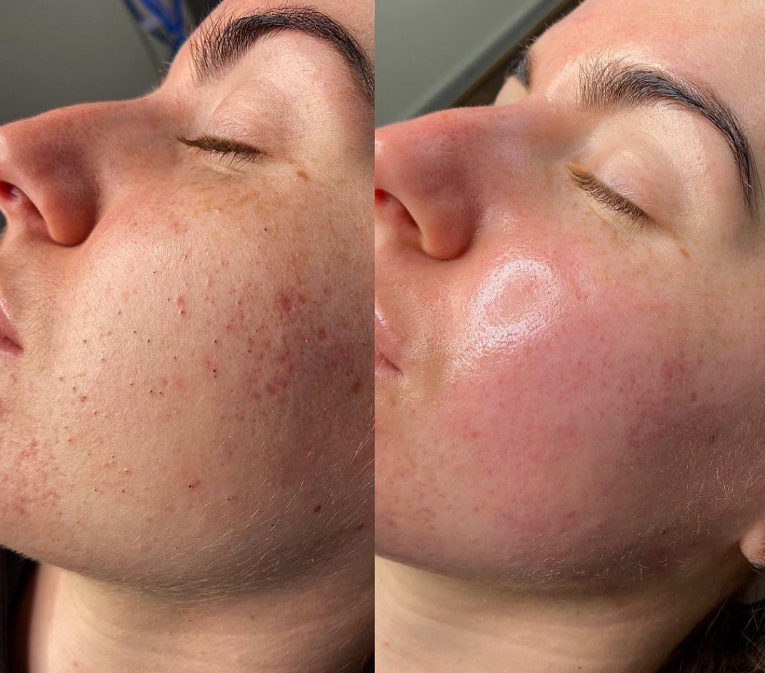 Clogged Pores