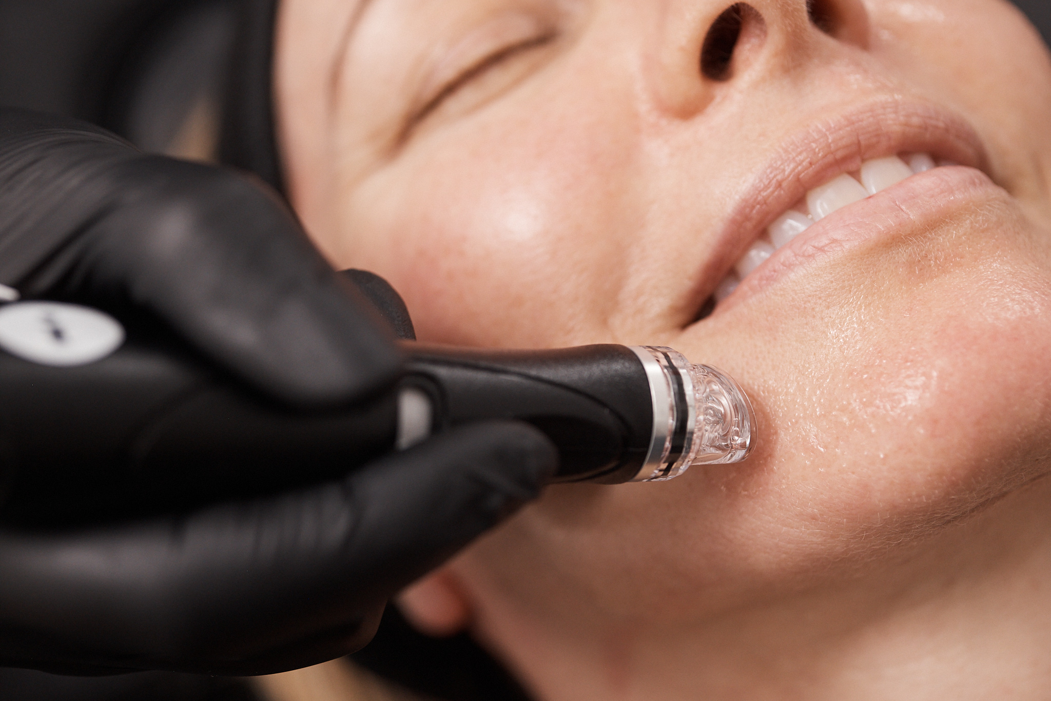 Hydrafacial