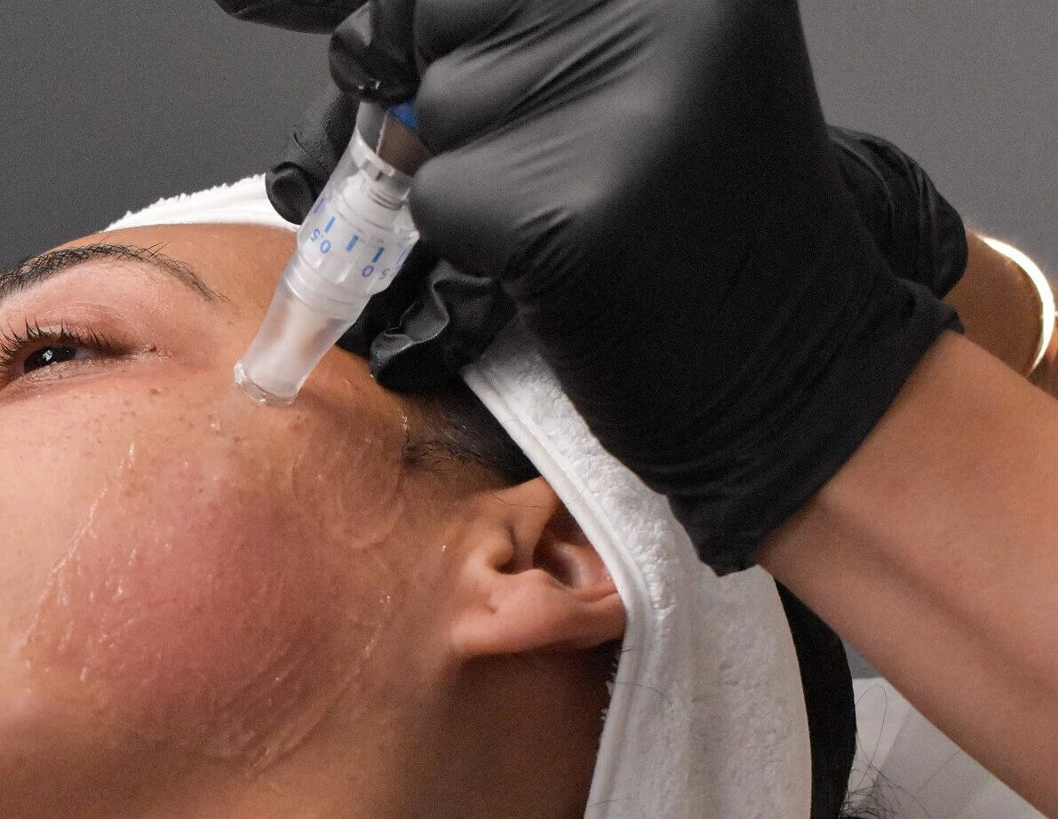 SkinPen Precision Elite profesionalni microneedling za obnovu kože