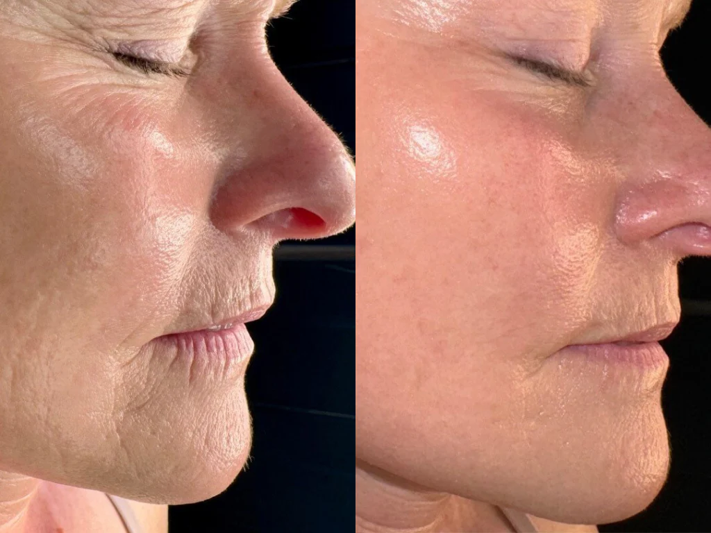 Primjer rezultata SkinPen Precision Elite microneedling tretmana za teksturu kože i ožiljke od akni