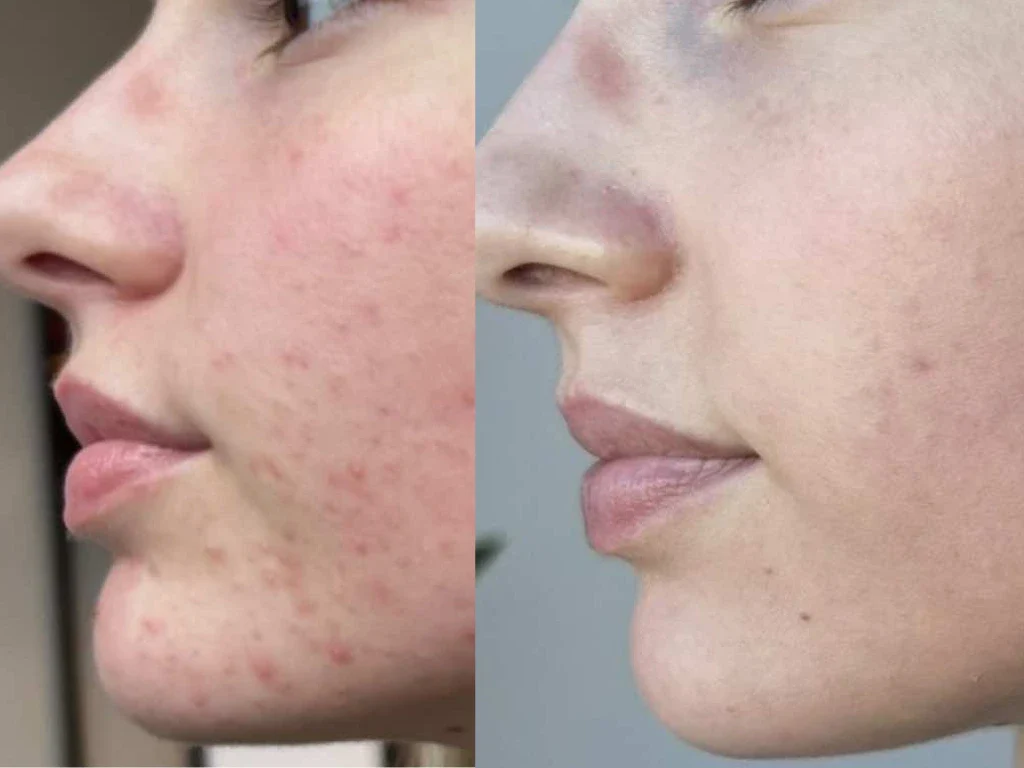 Primjer rezultata SkinPen Precision Elite tretmana za ujednačeniji ton i kvalitetu kože